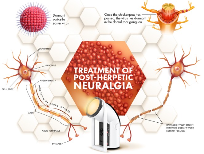 Bioptron und die Behandlung der postherpetischen Neuralgie des Ischiasnervs